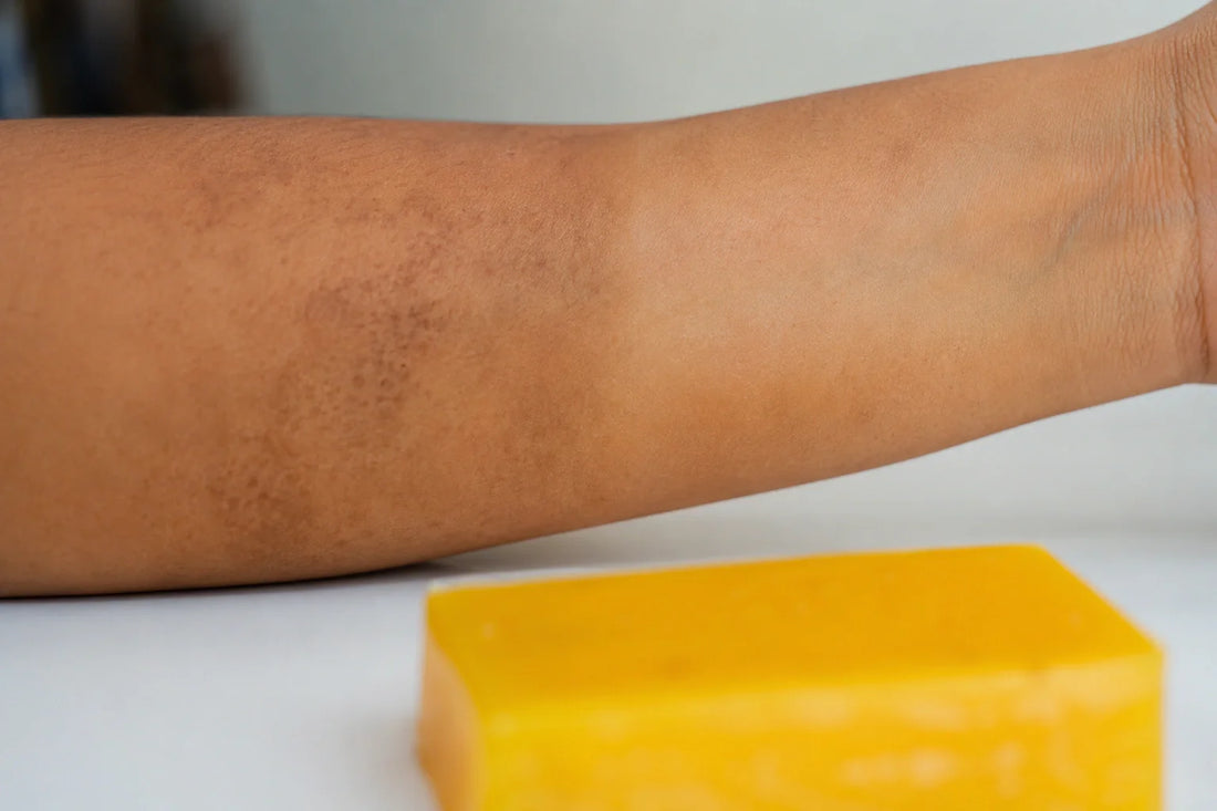Does KojieCare Really Work for Dark Spots? Honest Review