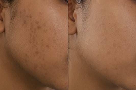 Kojic Acid Soap Before and After — What to Realistically Expect