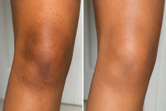 How to Fade Dark Knees — Why They Darken, What Actually Works, and What Real Results Look Like